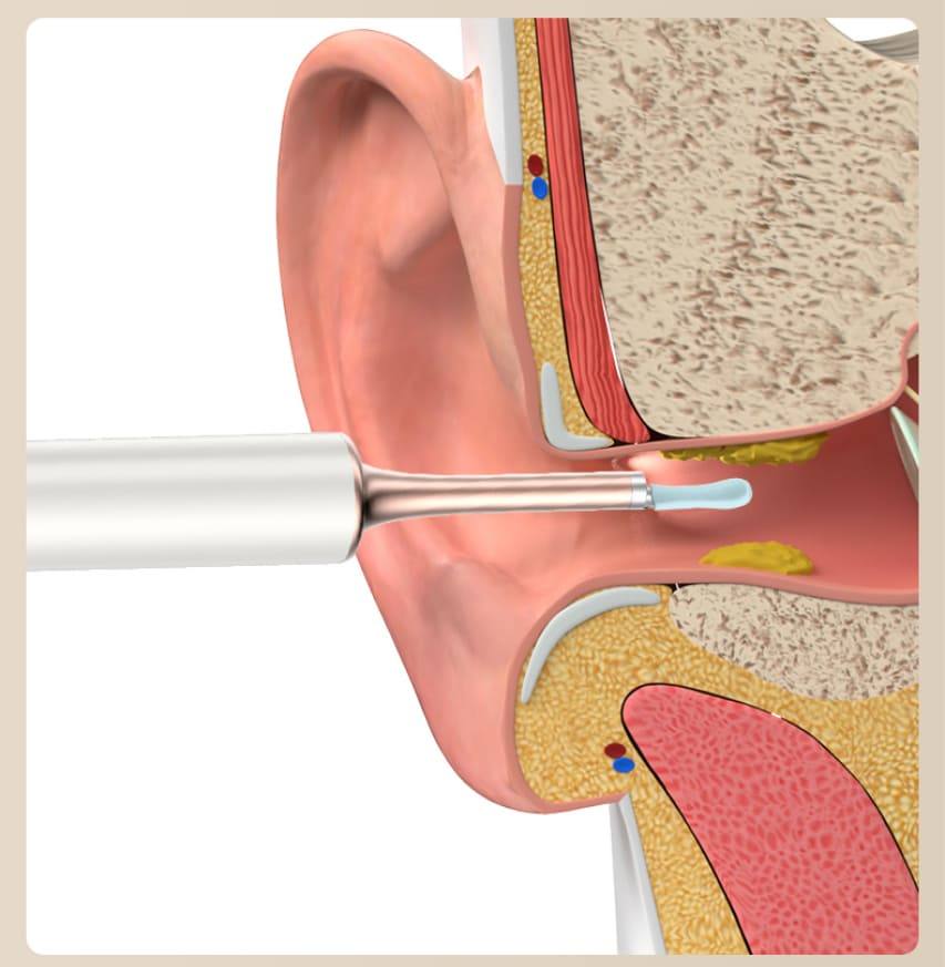 öronvaxborttagningsmedel som rengör örat